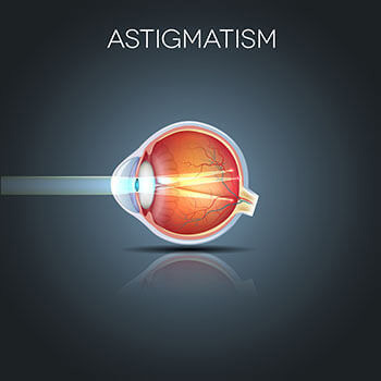 Astigmatism