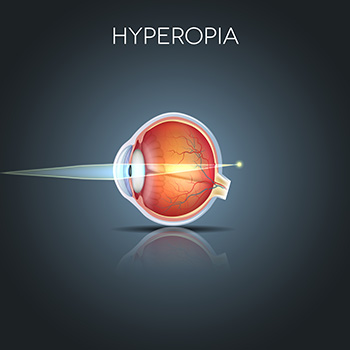 Hyperopia graphic