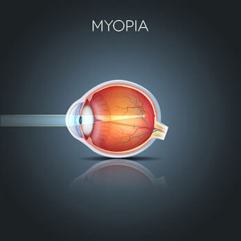 Myopia graphic