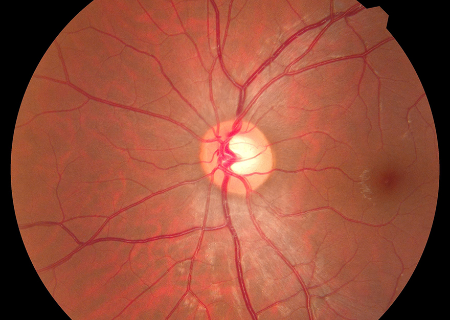 Optic Nerve Specialist Henderson Optic Nerve Damage Treatment
